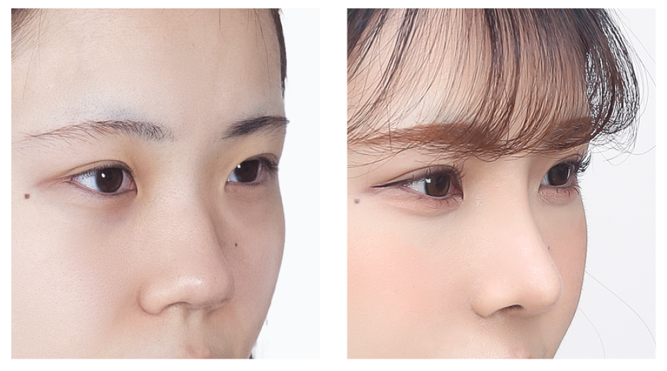 Nose Surgery in Busan