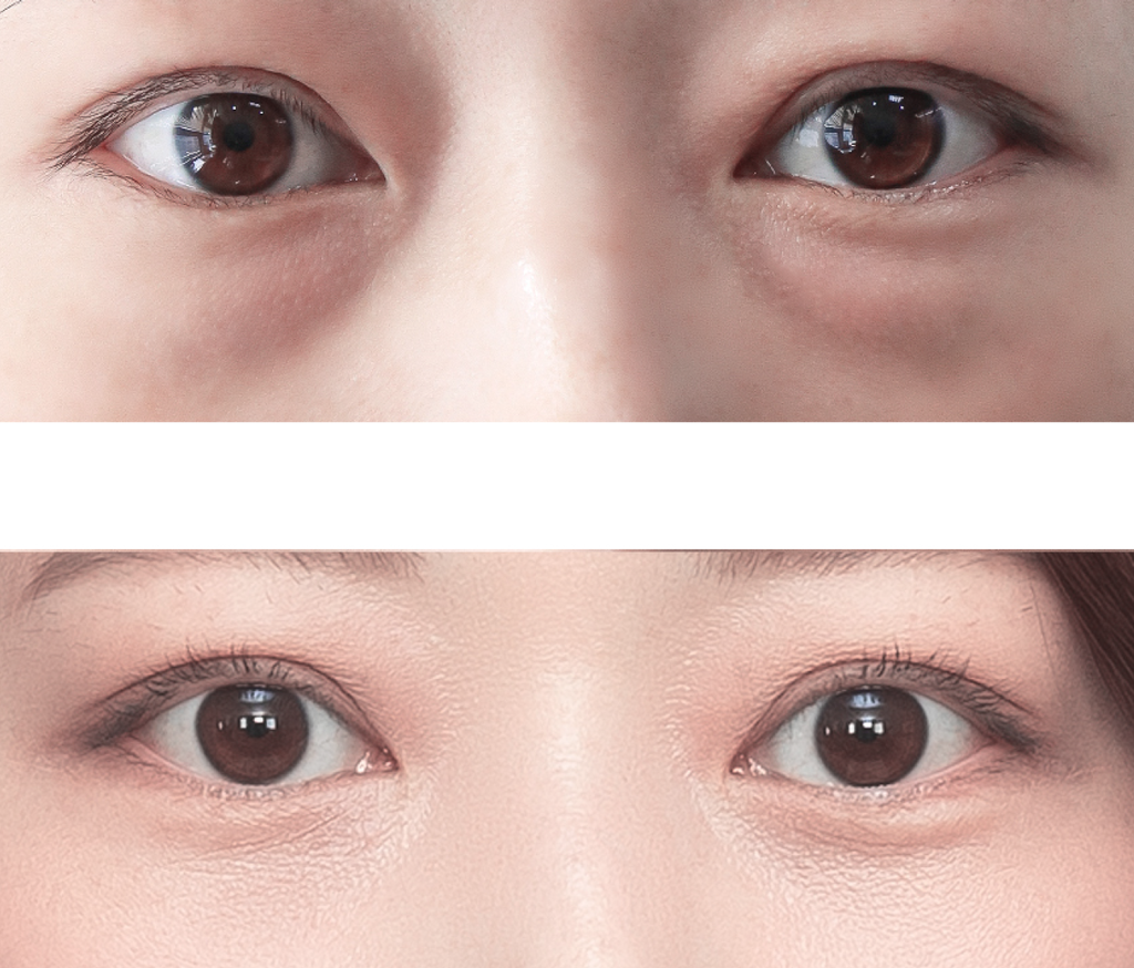 Under Eye Fat Repositioning in Busan