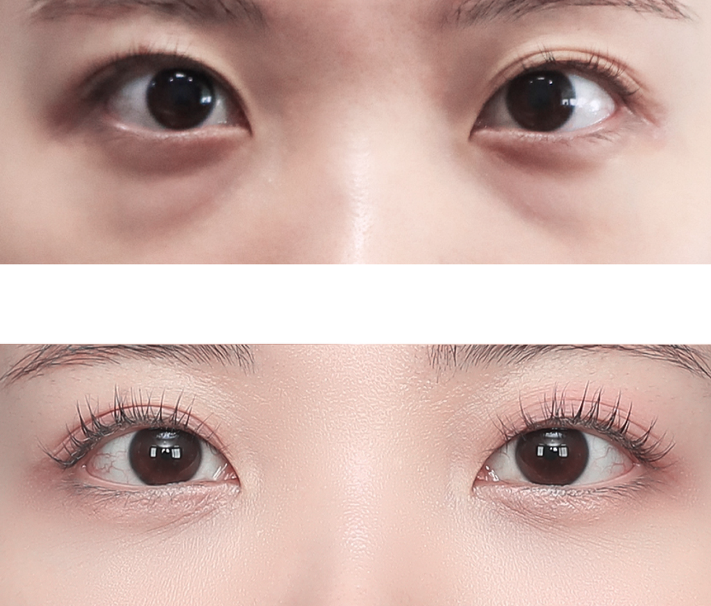 Under Eye Fat Repositioning in Busan