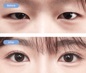 Double Eyelid Surgery in Busan