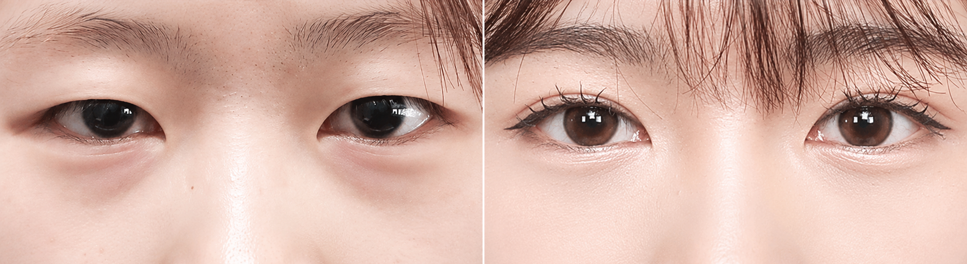 Plastic Surgery Cost in Korea