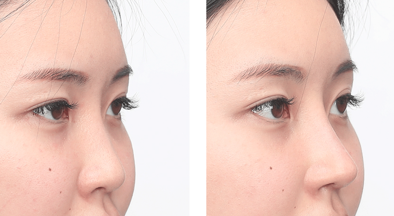 Plastic Surgery Cost in Korea