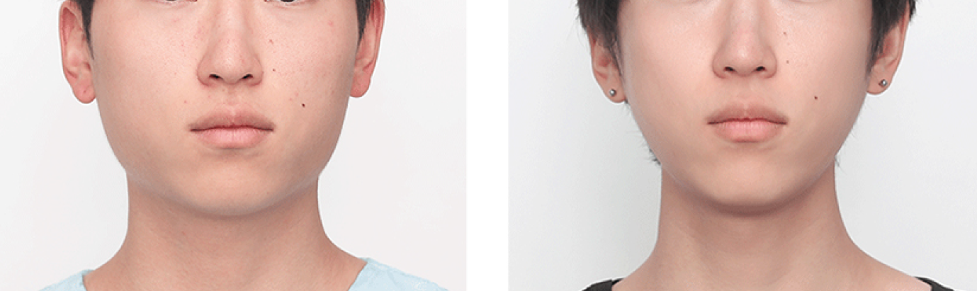Plastic Surgery Cost in Busan