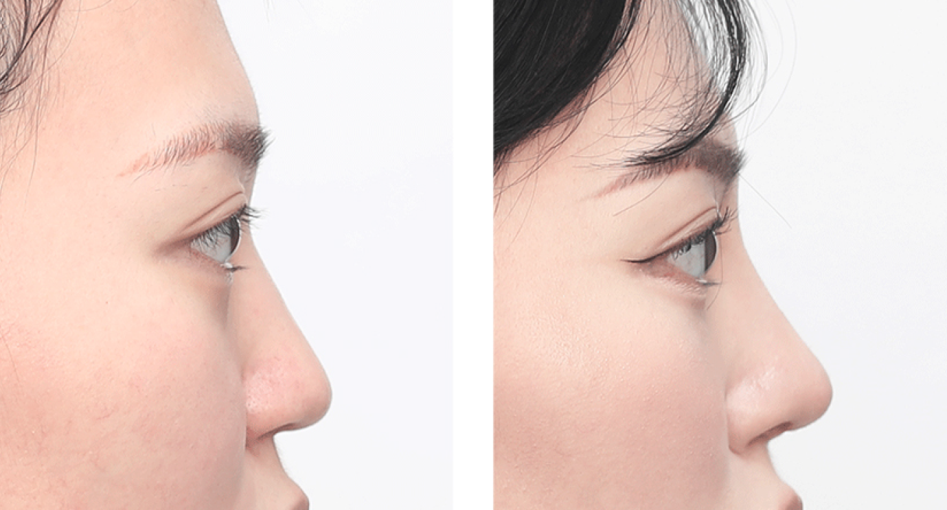 Rhinoplasty in Busan