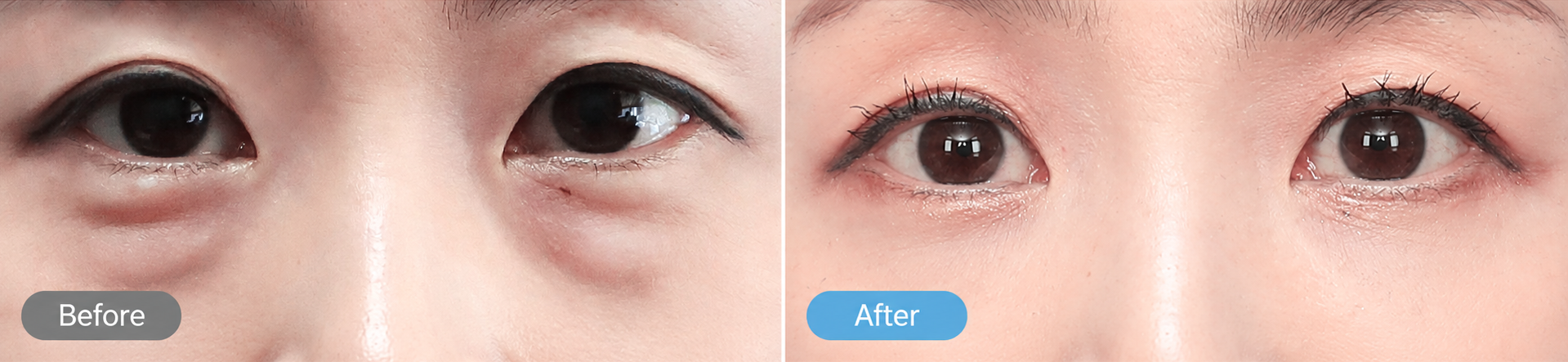 Under Eye Fat Repositioning in Korea