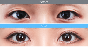 Asian Blepharoplasty in Busan (2)