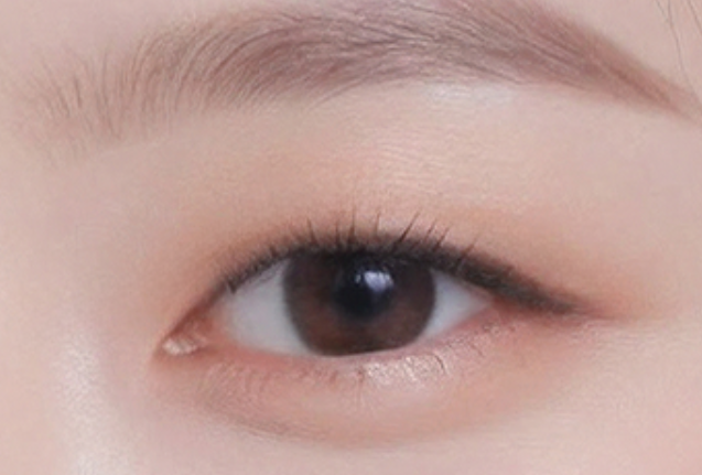 Asian Blepharoplasty in Busan