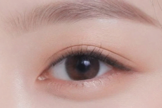Asian Blepharoplasty in Korea