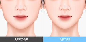 Botox in Busan