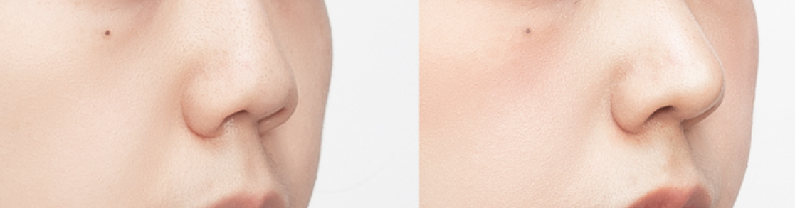 Nose Tip Surgery in Busan
