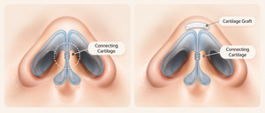 Nose Tip Surgery in Busan