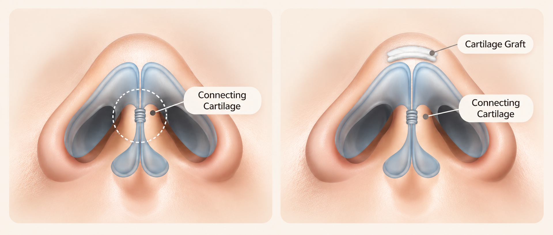 Nose Tip Surgery in Busan