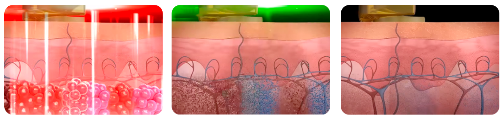 Pigmentation Treatment in Busan