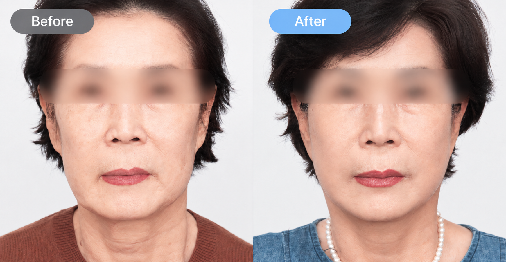 SMAS Facelift in Busan