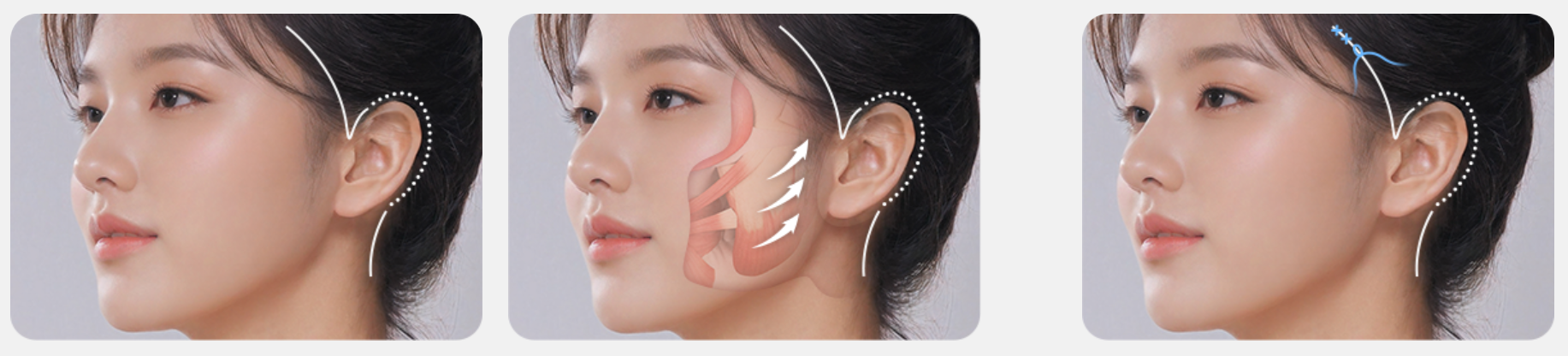 SMAS Facelift vs Ultherapy PRIME