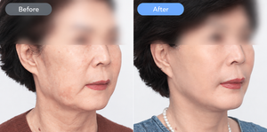 SMAS Facelift vs Ultherapy PRIME
