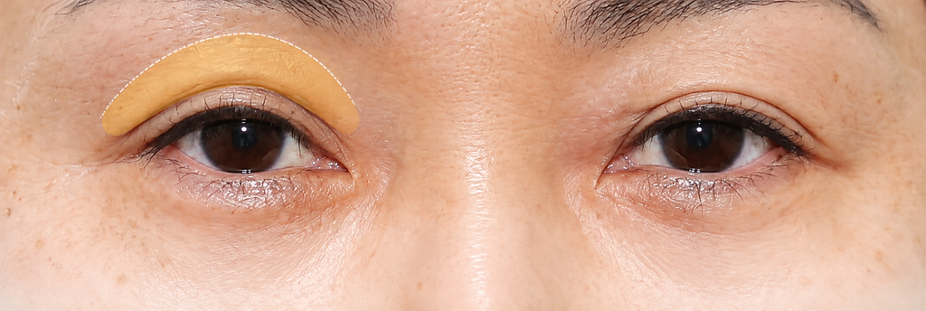 Upper Eyelid Fat Grafting in Busan