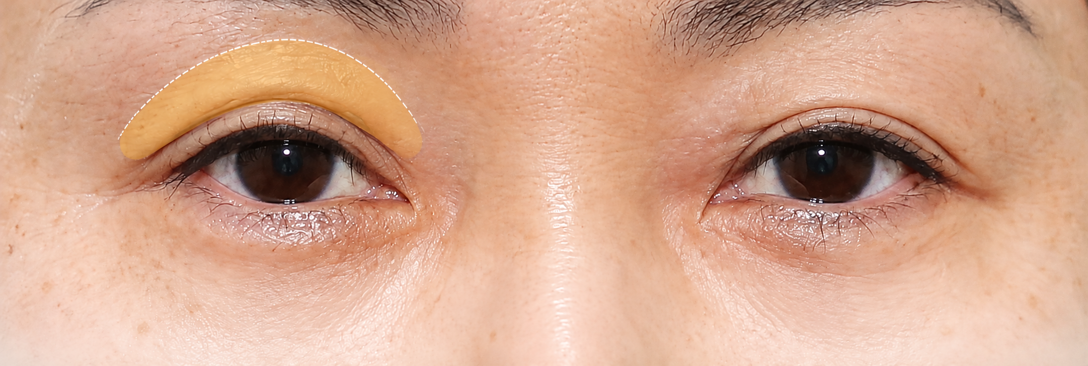 Upper Eyelid Fat Grafting in Busan