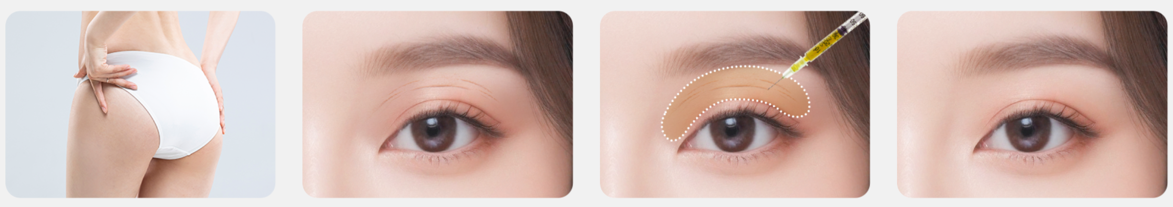 Upper Eyelid Fat Grafting in Busan